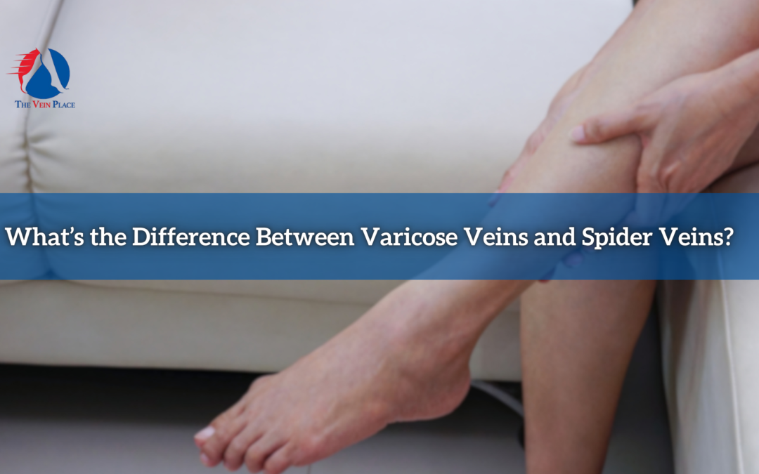 What’s the Difference Between Varicose Veins and Spider Veins?
