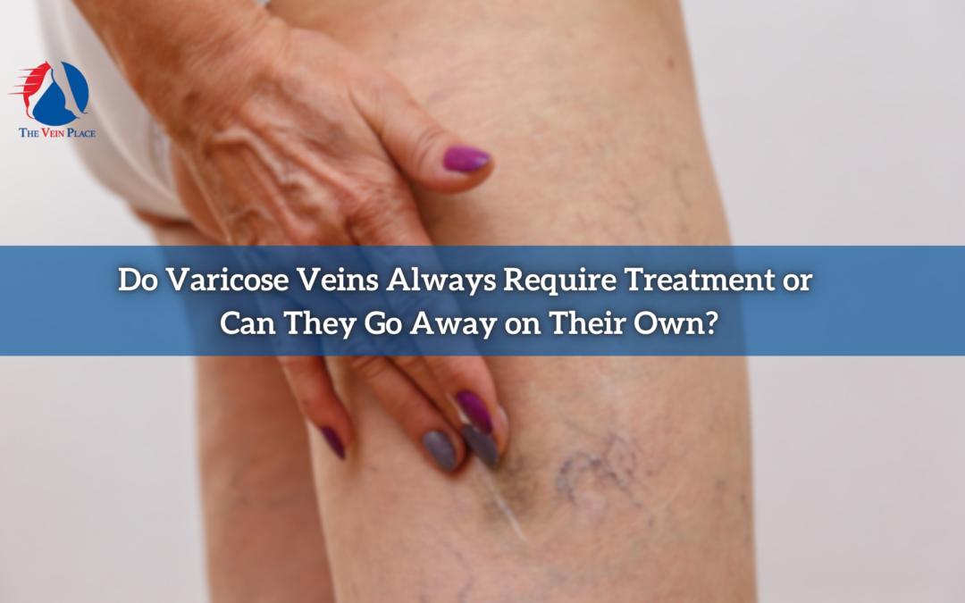 Do Varicose Veins Always Require Treatment or Can They Go Away on Their Own?
