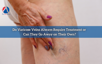 Do Varicose Veins Always Require Treatment or Can They Go Away on Their Own?