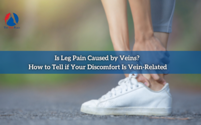 Is Leg Pain Caused by Veins? How to Tell if Your Discomfort Is Vein-Related