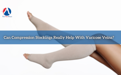 Can Compression Stockings Really Help With Varicose Veins?