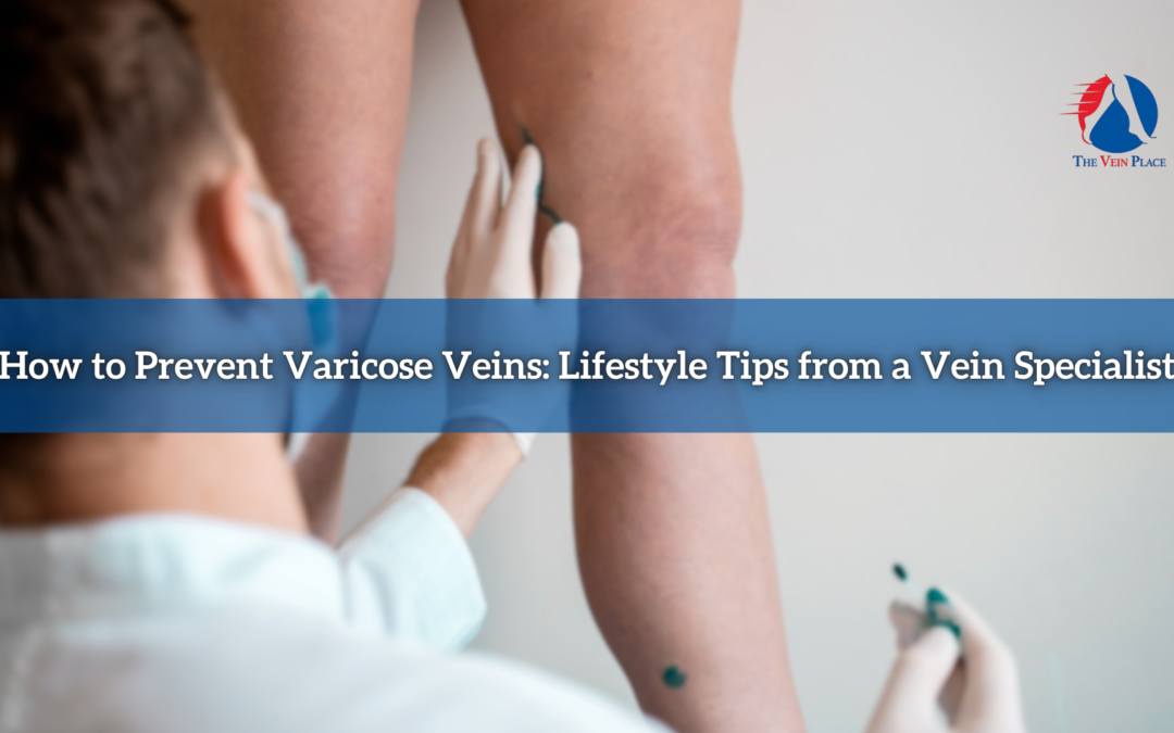 How to Prevent Varicose Veins: Lifestyle Tips from a Vein Specialist