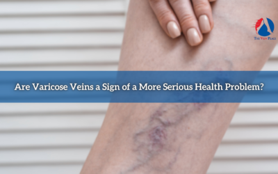Are Varicose Veins a Serious Problem? ⚠️🩺