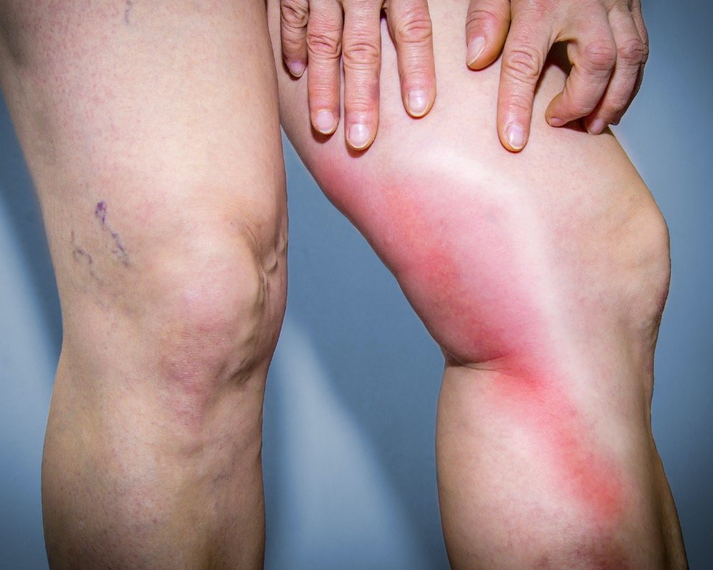 Redness and visible vein issues on leg.