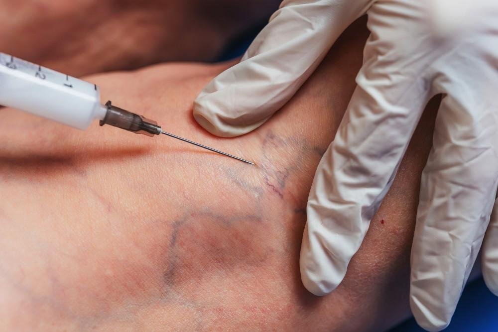 Laser vein treatment procedure on visible leg veins.