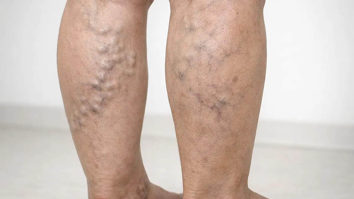 Severe varicose veins visible on lower legs.