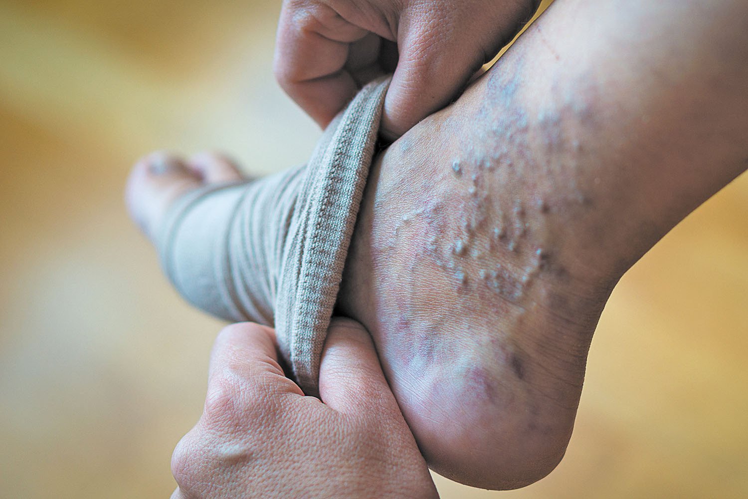Varicose vein skin changes near the ankle with compression stocking support.
