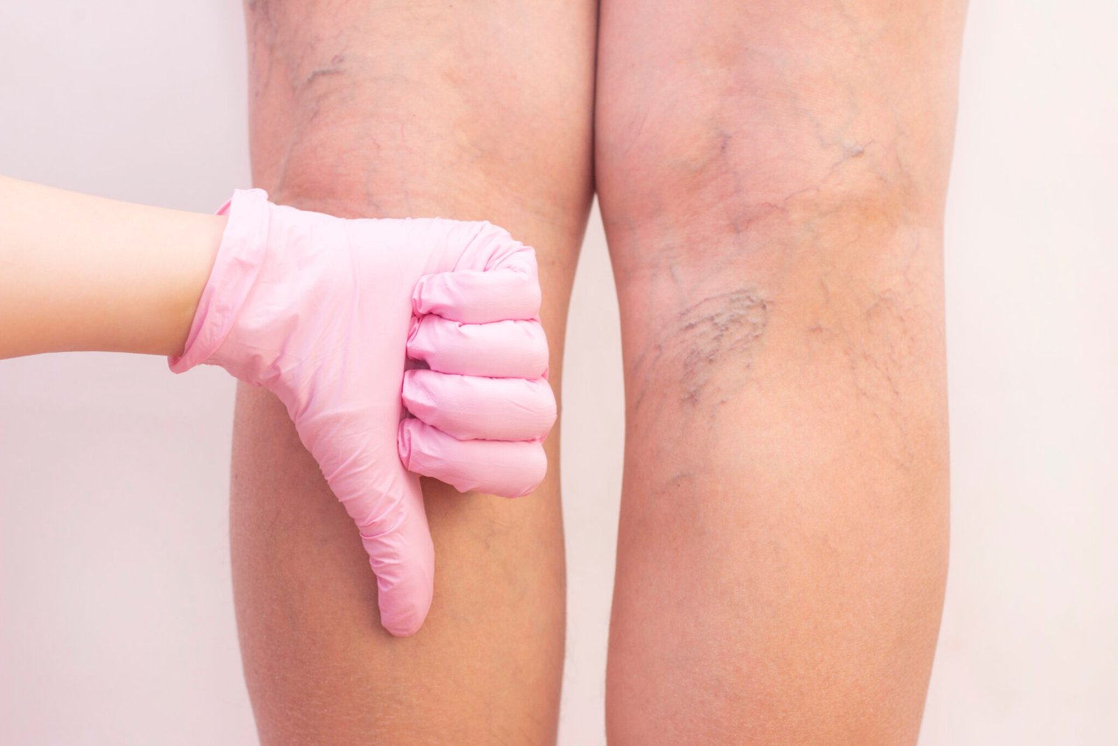 Visible varicose veins on legs.