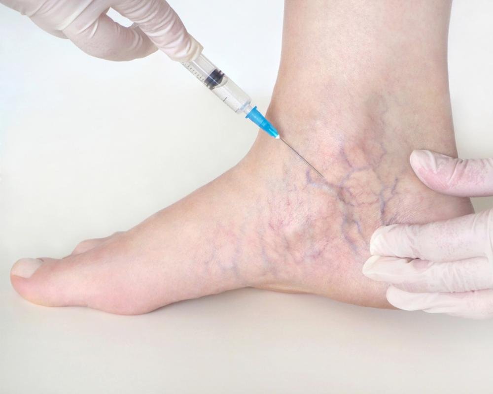 Spider vein injection treatment on ankle.