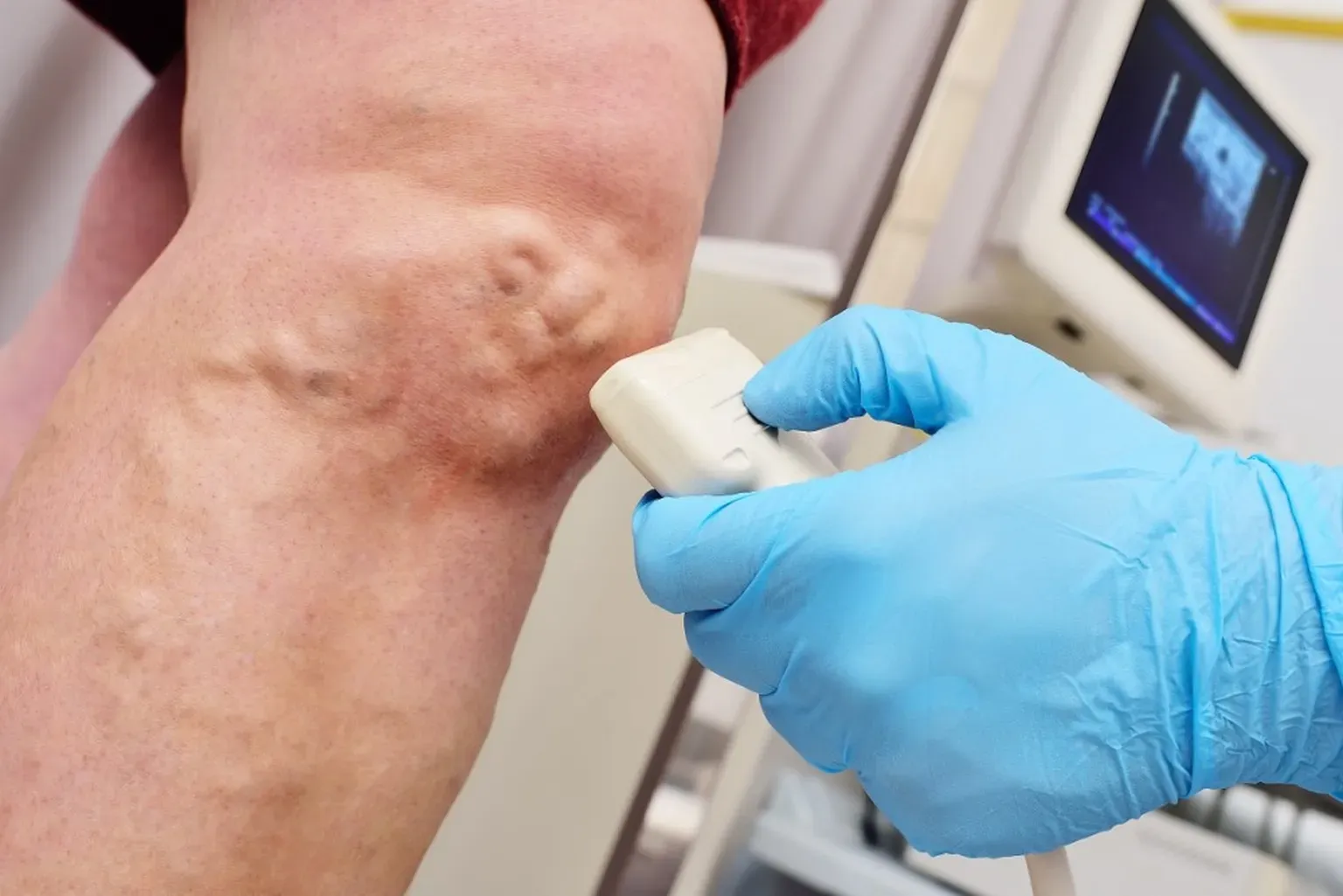 Ultrasound-guided sclerotherapy for visible leg veins.  