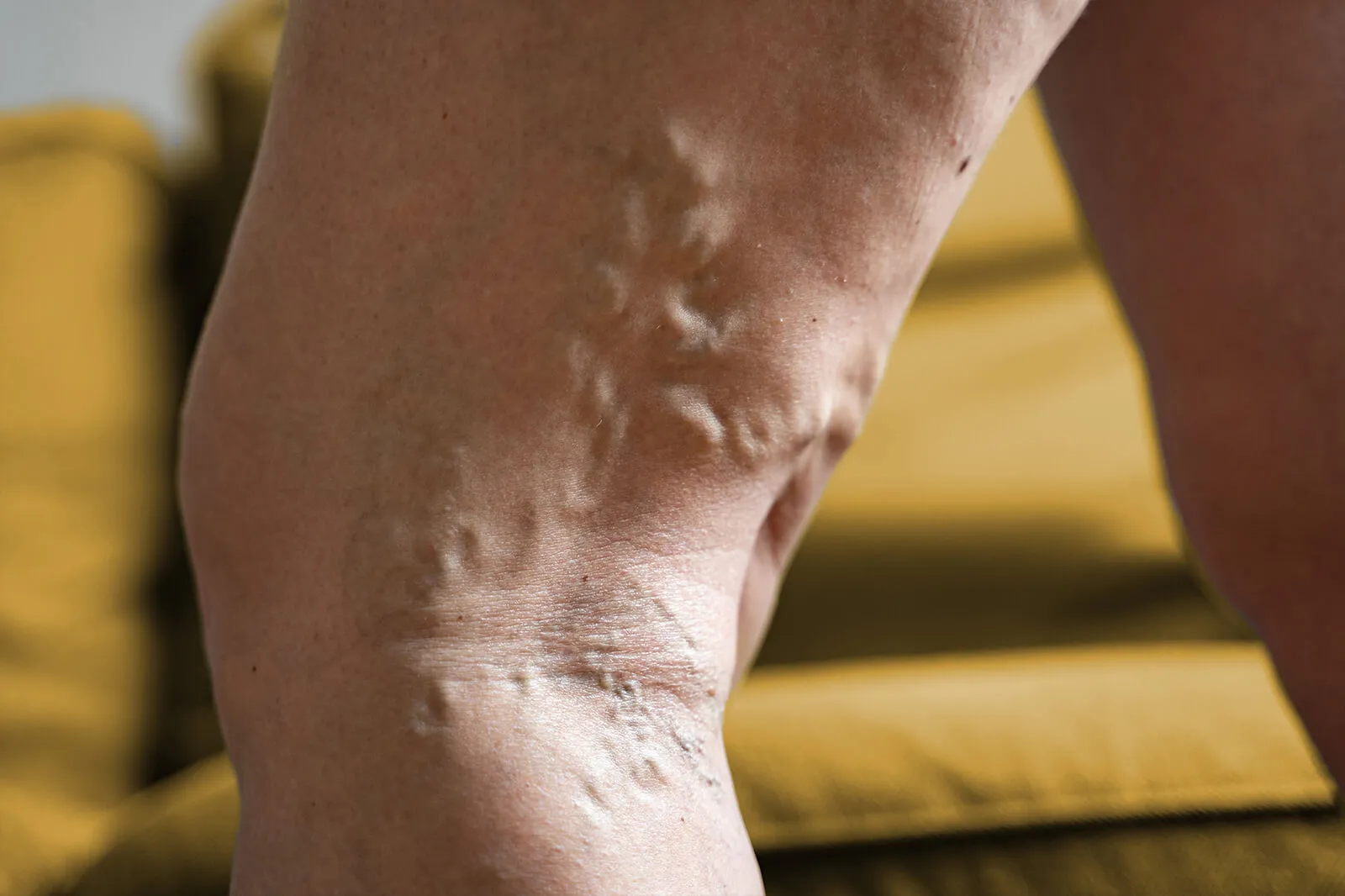 Bulging varicose veins on the back of a patient’s leg.