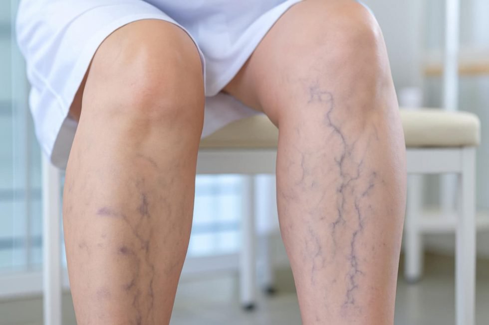 Visible leg veins on a patient’s calves.