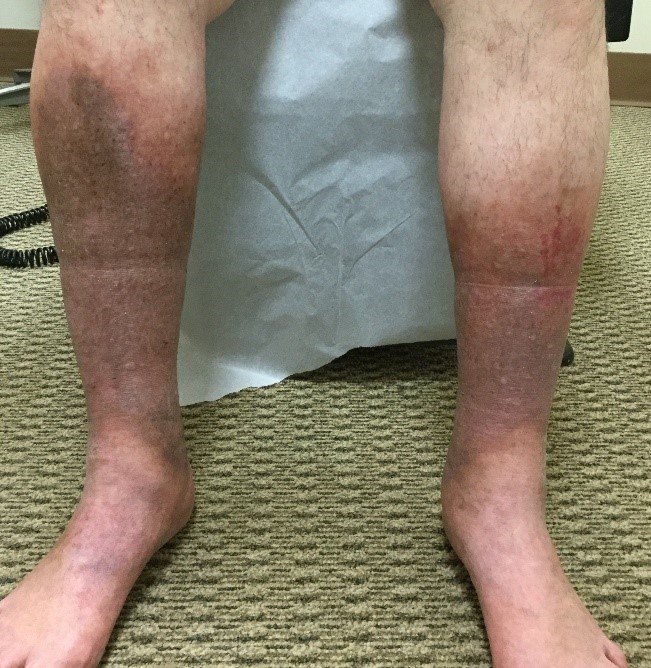 Skin discoloration and swelling from chronic venous insufficiency.