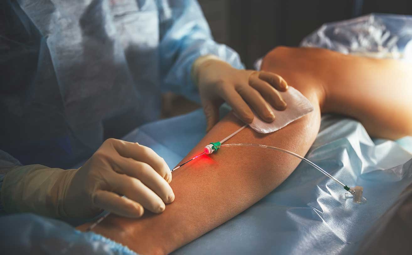 Alt text: Minimally invasive varicose vein laser treatment on a patient’s leg. 