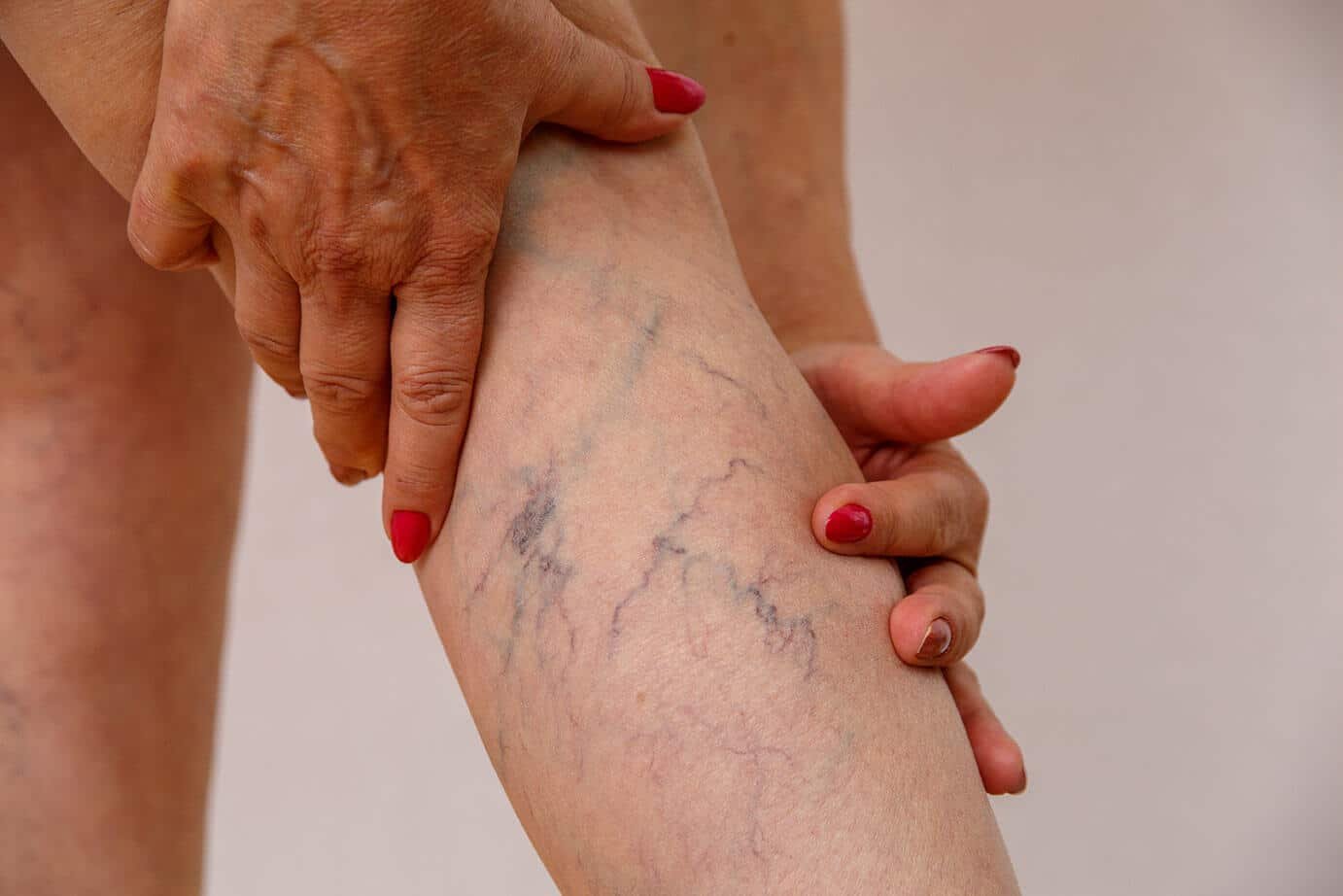 Early visible vein changes on a patient’s leg. 
