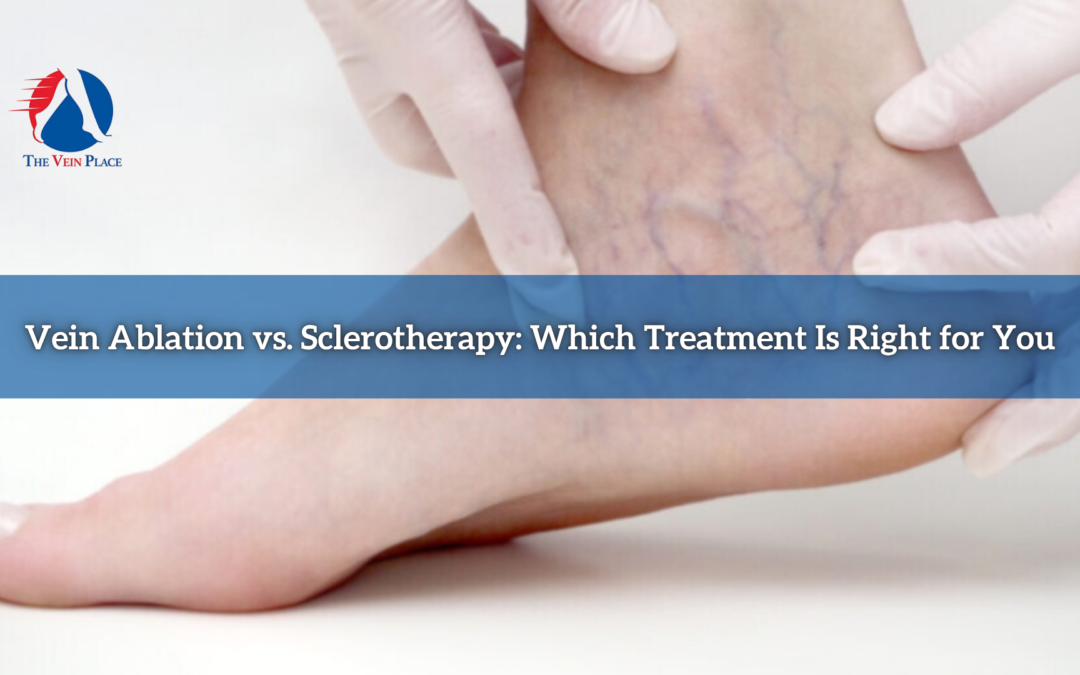 Vein Ablation vs. Sclerotherapy: Which Treatment Is Right for You