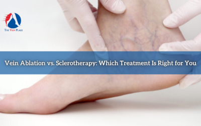 Vein Ablation vs. Sclerotherapy: Which Treatment Is Right for You