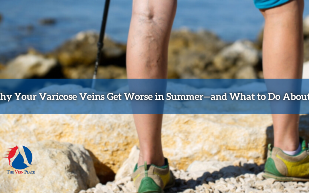 Why Your Varicose Veins Get Worse in Summer—and What to Do About It