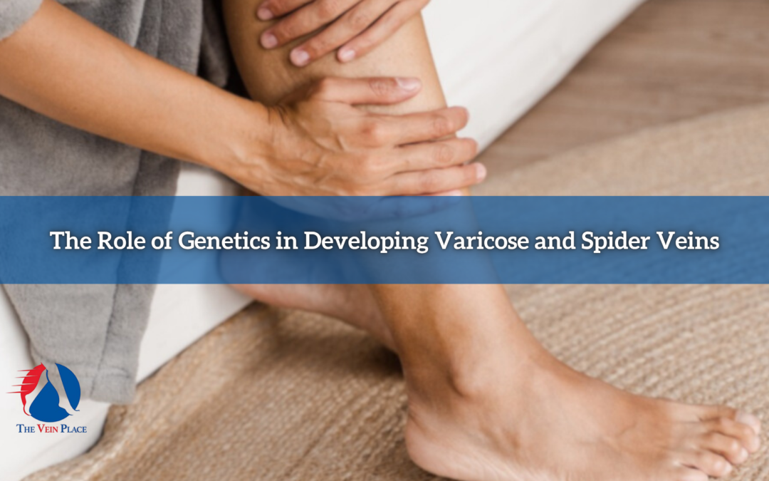 The Role of Genetics in Developing Varicose and Spider Veins