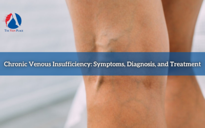 Chronic Venous Insufficiency: Symptoms, Diagnosis, and Treatment