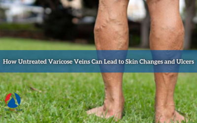 How Untreated Varicose Veins Can Lead to Skin Changes and Ulcers