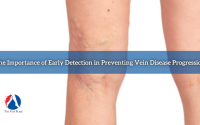 The Importance of Early Detection in Preventing Vein Disease Progression