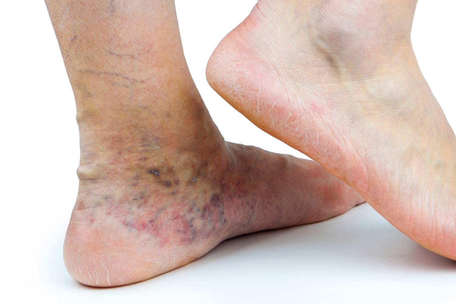 Skin discoloration around the ankle from untreated vein disease. 