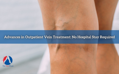 Advances in Outpatient Vein Treatment: No Hospital Stay Required