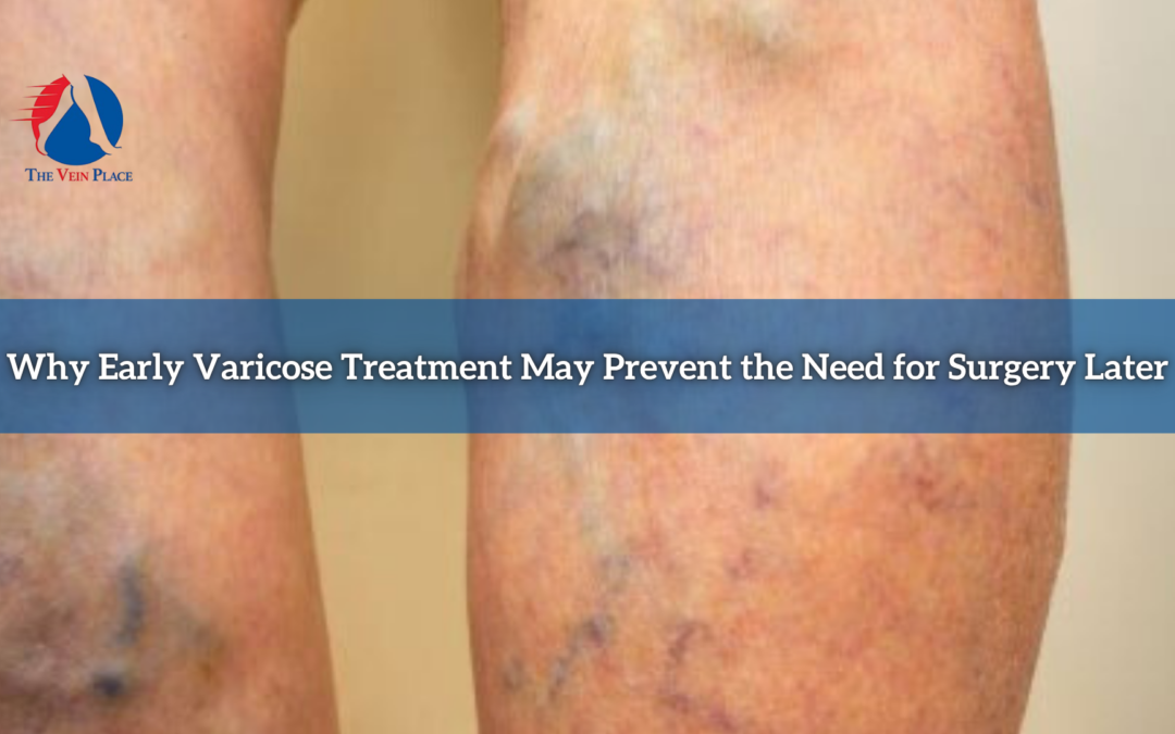 Why Early Varicose Treatment May Prevent the Need for Surgery Later