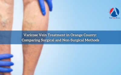 Varicose Vein Treatment in Orange County: Comparing Surgical and Non-Surgical Methods