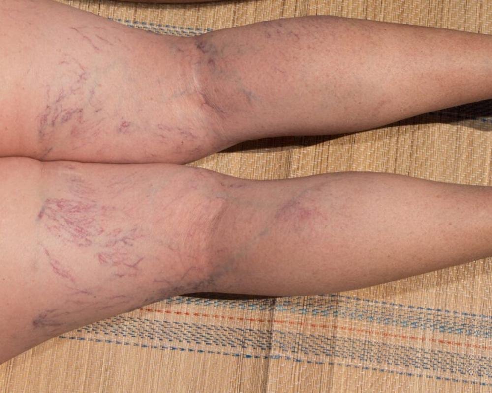 Comparison of spider veins and varicose veins on legs.