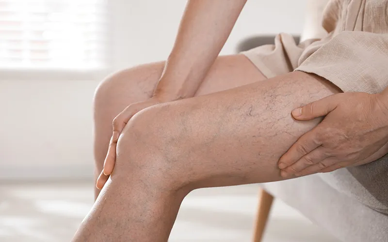 Varicose veins visible on a person's lower leg.