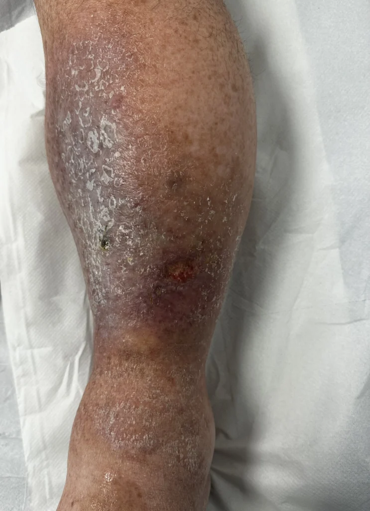 Lower leg with skin changes, swelling, and a venous ulcer.