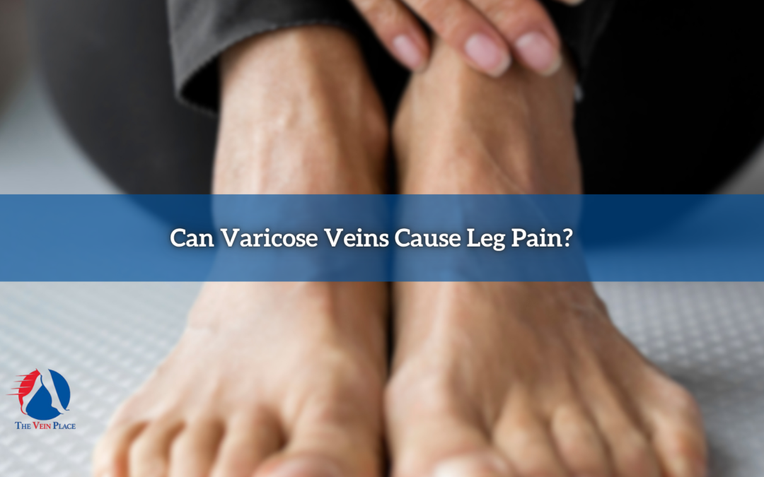 Can Varicose Veins Cause Leg Pain?