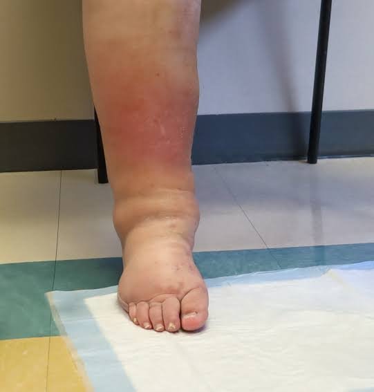 Severely swollen lower leg and foot showing skin redness
