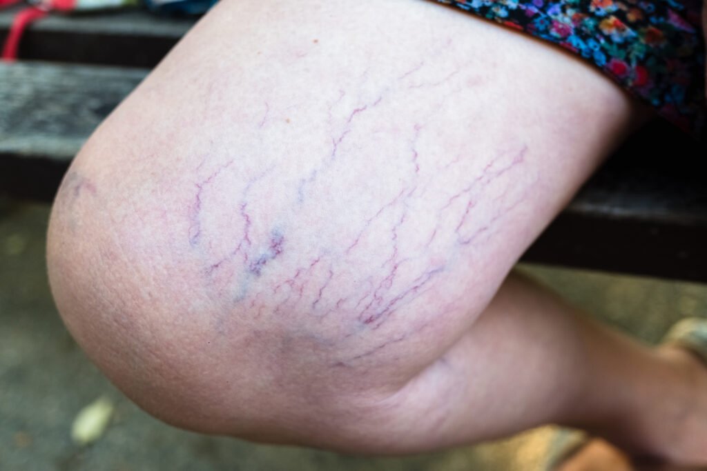 Visible spider veins on the leg.