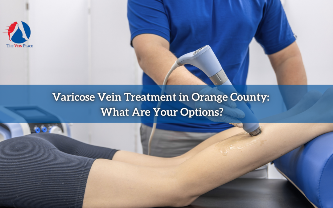 Varicose Vein Treatment in Orange County: What Are Your Options?