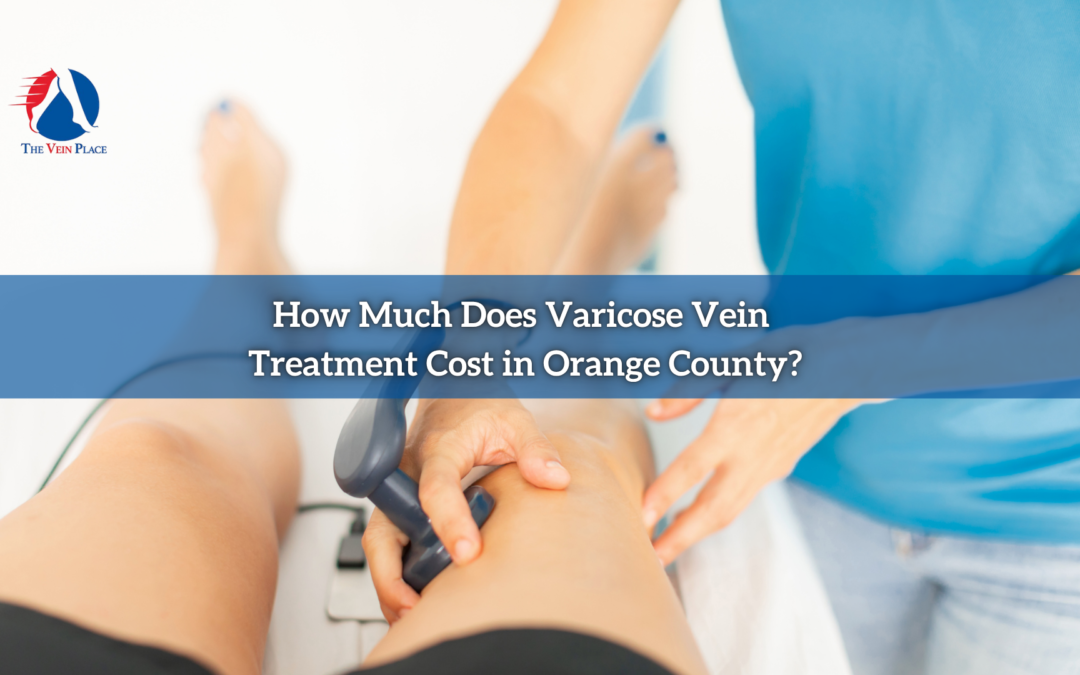 How Much Does Varicose Vein Treatment Cost in Orange County?