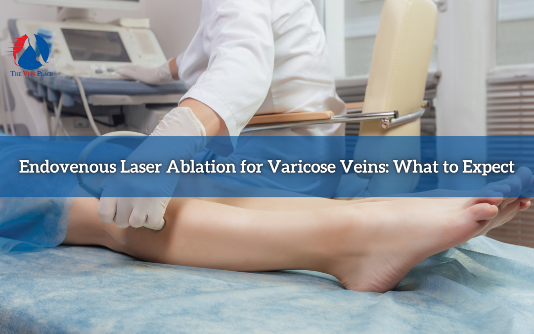 Endovenous Laser Ablation for Varicose Veins: What to Expect