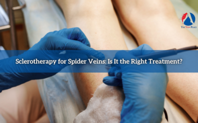 Sclerotherapy for Spider Veins: Is It the Right Treatment?
