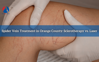 Spider Vein Treatment in Orange County: Sclerotherapy vs. Laser