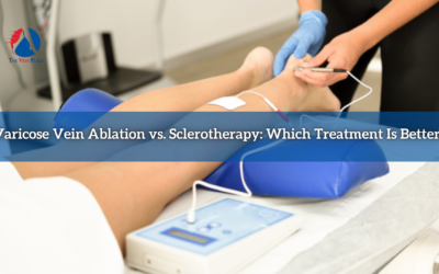 Varicose Vein Ablation vs. Sclerotherapy: Which Treatment Is Better?