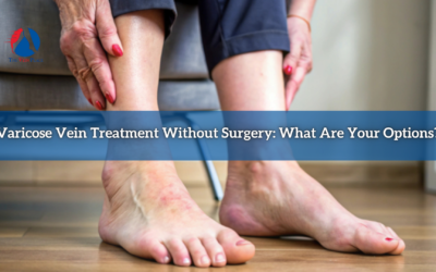 Varicose Vein Treatment Without Surgery: What Are Your Options?