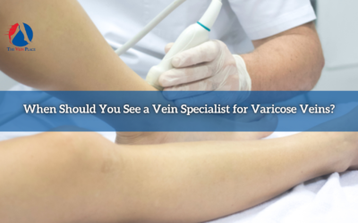 When Should You See a Vein Specialist for Varicose Veins?