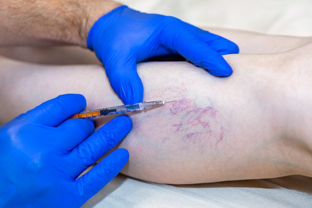 2312 Laser treatment being performed on visible spider veins.