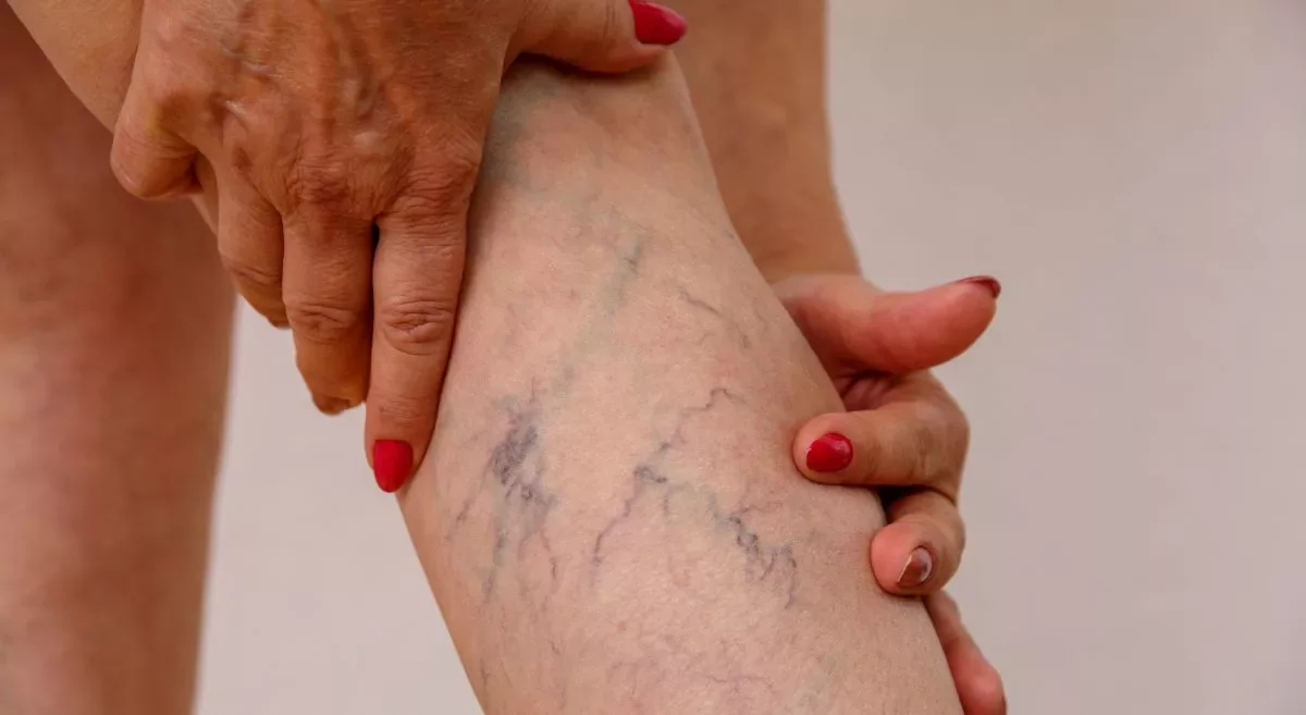 Varicose veins on a woman's leg