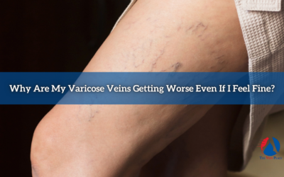 Why Are My Varicose Veins Getting Worse Even If I Feel Fine?