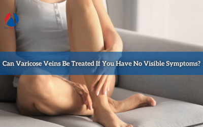 Can Varicose Veins Be Treated If You Have No Visible Symptoms?