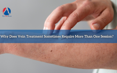 Why Does Vein Treatment Sometimes Require More Than One Session?